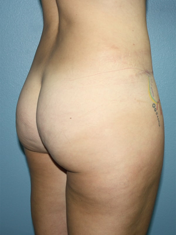 Case--9792 | Before Butt Lift