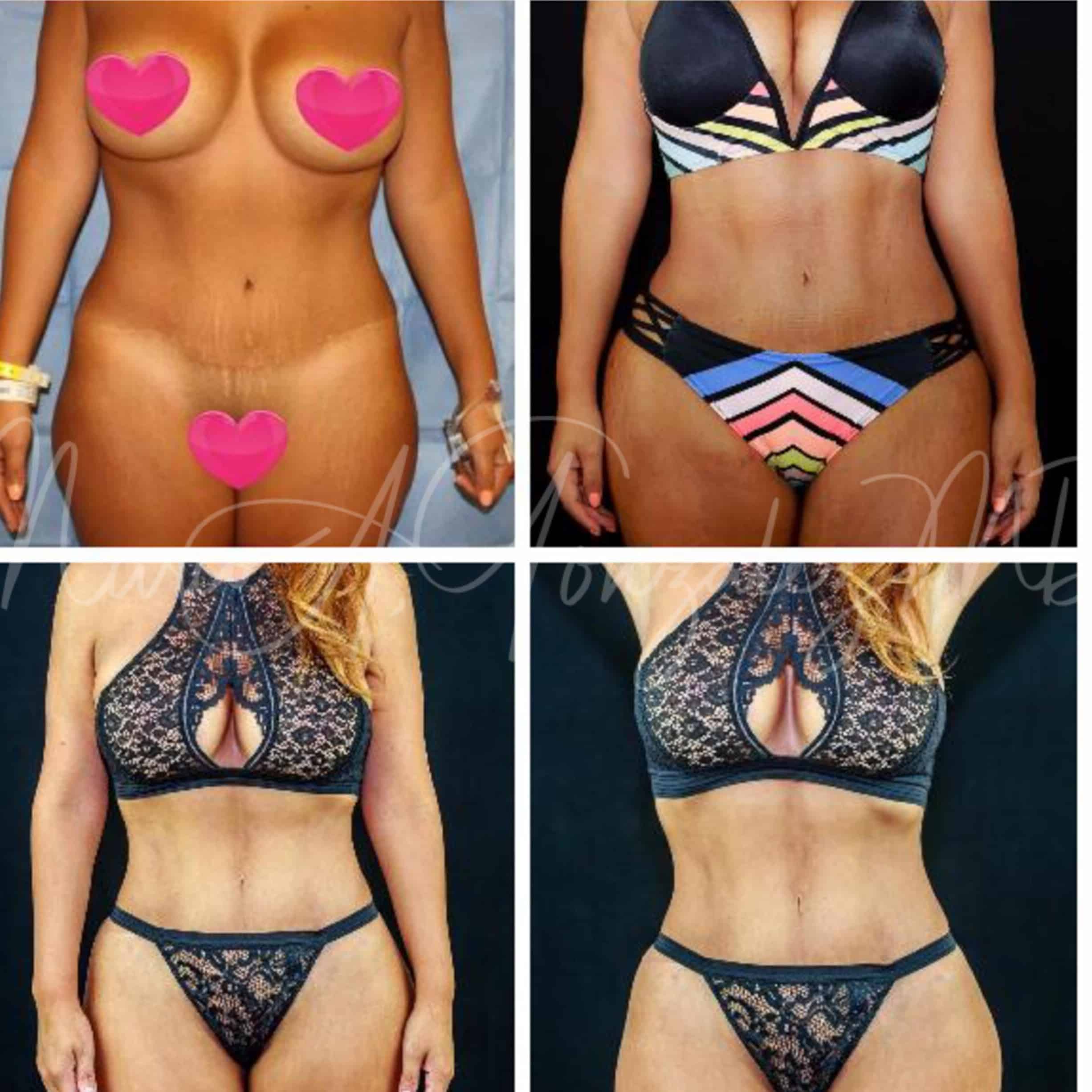 Case--8629 | Before Liposuction
